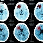 Immagine di alcune radiografie al cervello. La diagnostica per immagini utilizza sempre più spesso tecniche avanzate di analisi dei dati e Intelligenza Artificiale. ProBio è un progetto di ricerca sull'utilizzo dei Big Data e dell'Intelligenza Artificiale per la medicina di precisione in campo oncologico